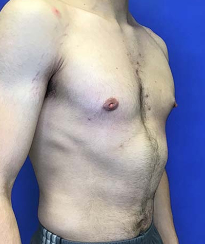 Gynecomastia case #4137