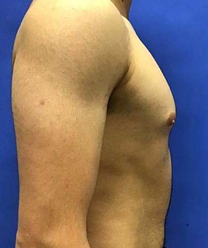 Gynecomastia case #4137