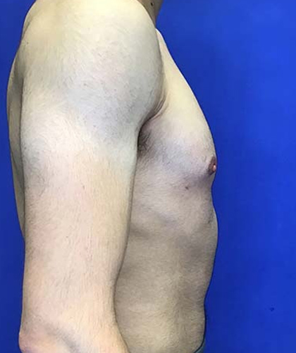 Gynecomastia case #4137