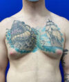 Gynecomastia case #4217