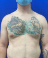 Gynecomastia case #4217