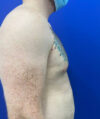 Gynecomastia case #4217