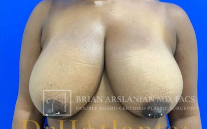 Breast Reduction case #2881