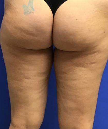 Liposuction case #3676