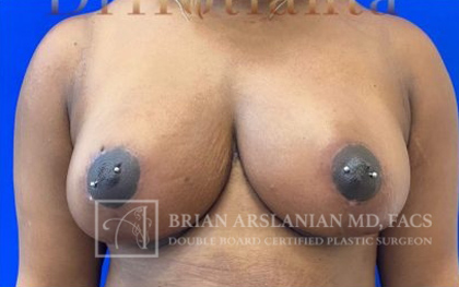 Breast Reduction case #2881