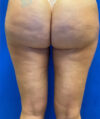 Liposuction case #3676