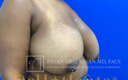 Breast Reduction case #2881