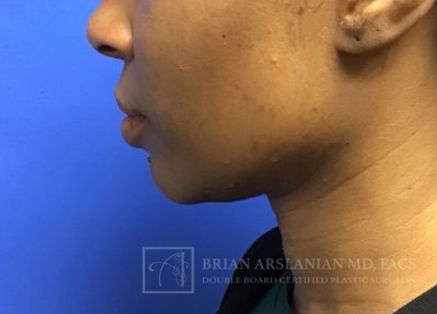 Fillers case #3552