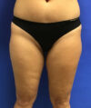 Liposuction case #3676