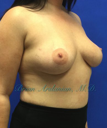 Breast Augmentation case #2628