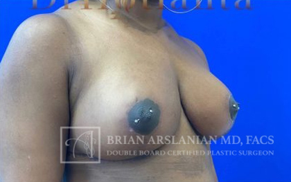 Breast Reduction case #2881