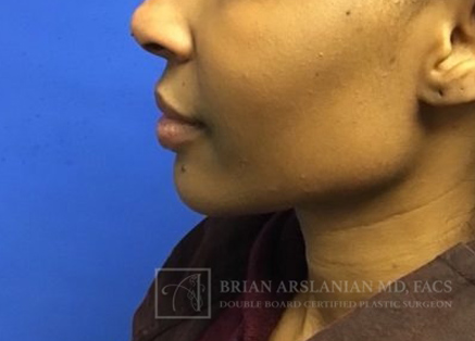 Fillers case #3552