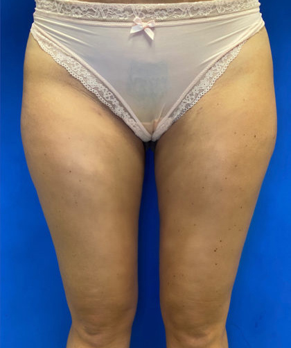 Liposuction case #3676