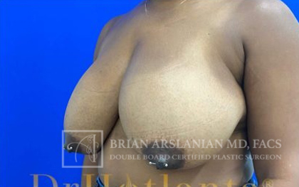 Breast Reduction case #2881