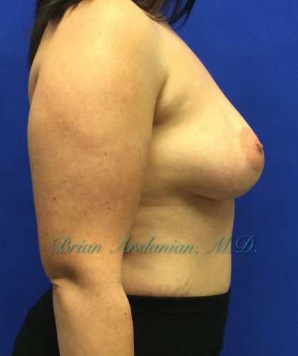 Breast Augmentation case #2628