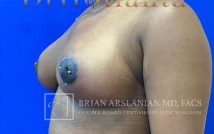 Breast Reduction case #2881