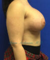 Breast Augmentation case #2628