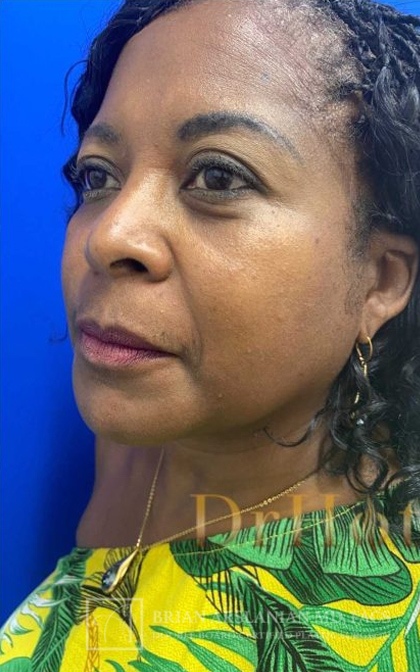 Profound RF Microneedling case #3089