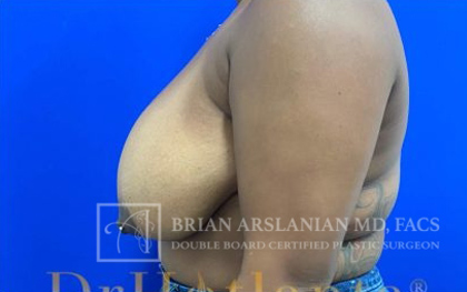 Breast Reduction case #2881