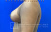 Breast Reduction case #2881