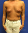 Breast Augmentation case #2636