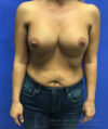 Breast Augmentation case #2636