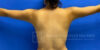 Liposuction case #3681