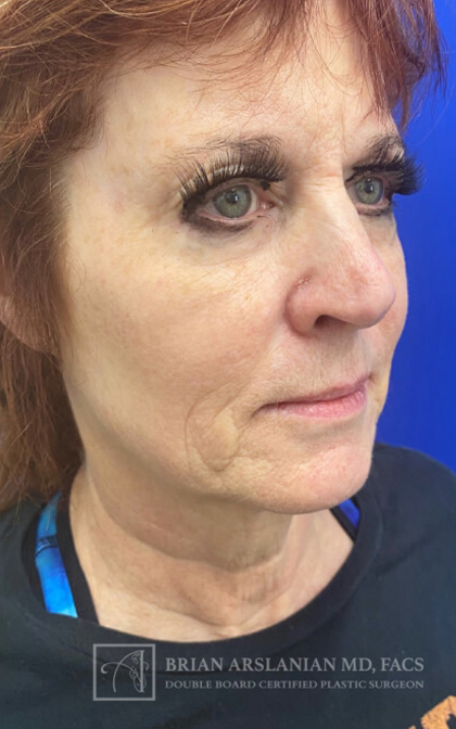 Profound RF Microneedling case #3101