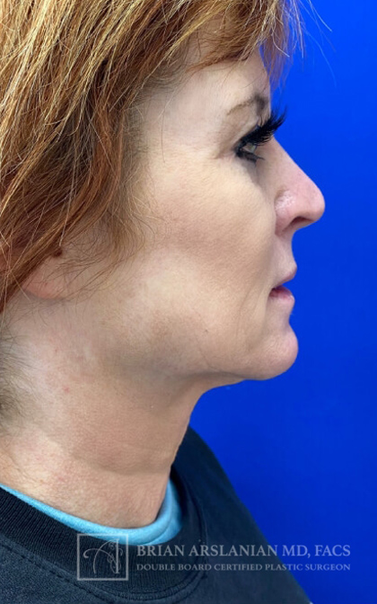 Profound RF Microneedling case #3101