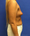 Breast Augmentation case #2636