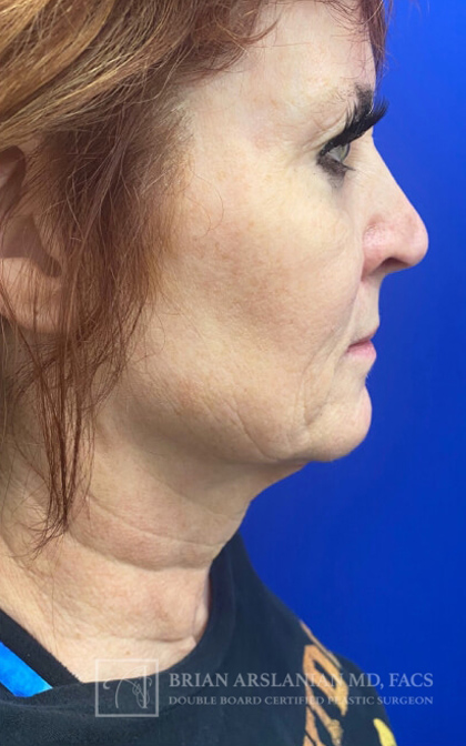 Profound RF Microneedling case #3101