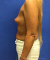 Breast Augmentation case #2636