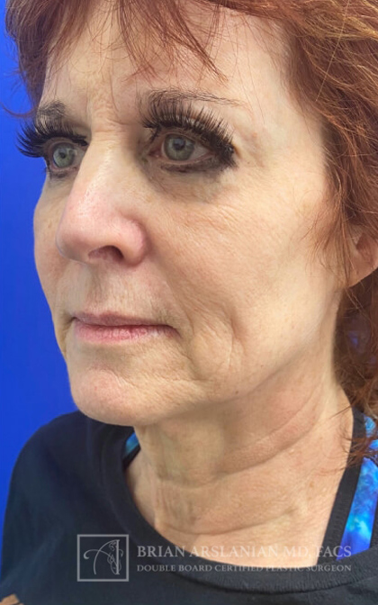 Profound RF Microneedling case #3101