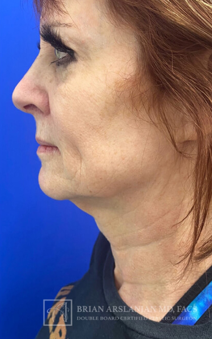 Profound RF Microneedling case #3101