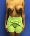 Breast Augmentation case #2647