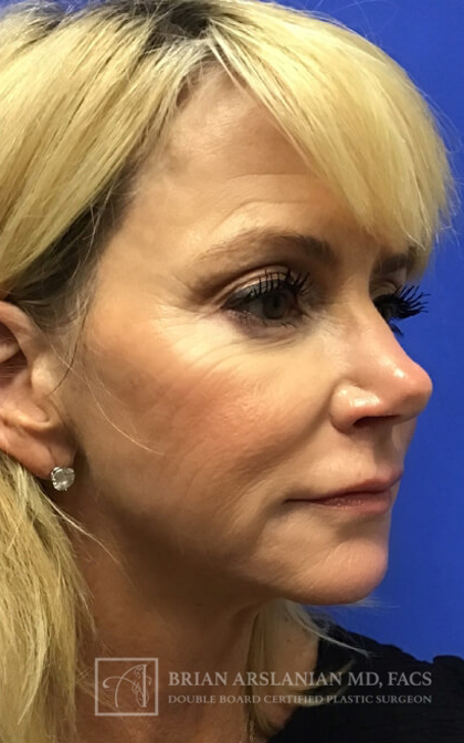 Profound RF Microneedling case #3112