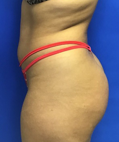 Liposuction case #3685