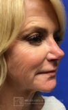 Profound RF Microneedling case #3112