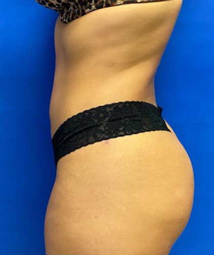 Liposuction case #3685