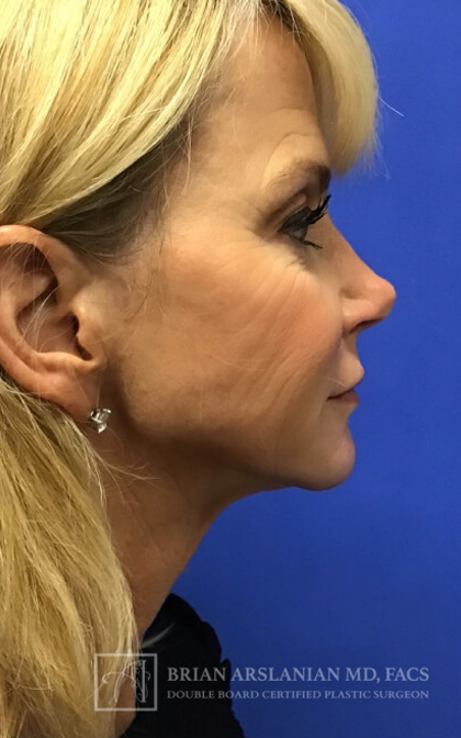 Profound RF Microneedling case #3112