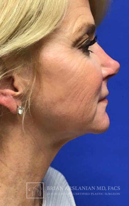 Profound RF Microneedling case #3112