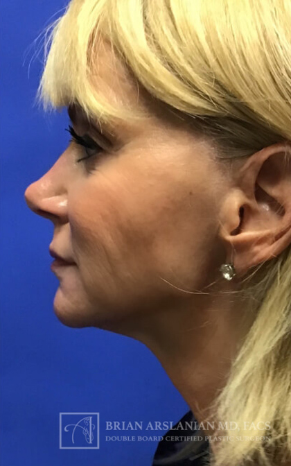 Profound RF Microneedling case #3112