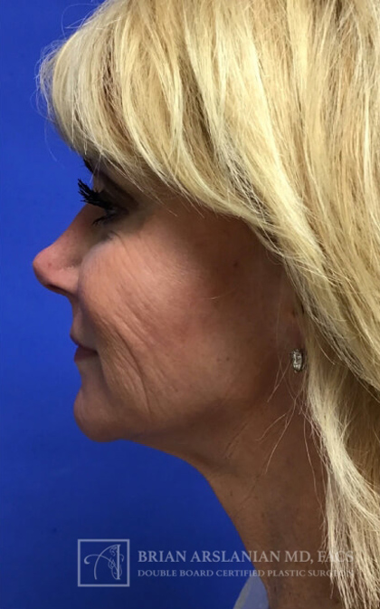 Profound RF Microneedling case #3112