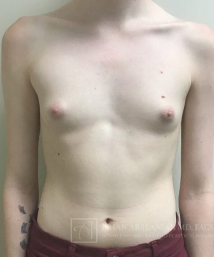 | Arslanian Plastic Surgery Atlanta Before & After Plastic Surgery Results | breast mtf procedure
