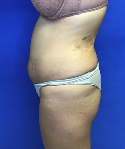 Liposuction case #3690