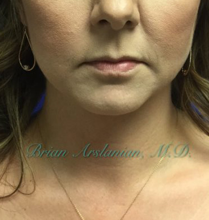 Neck Liposuction case #3821