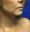 Neck Liposuction case #3821