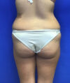 Liposuction case #3690