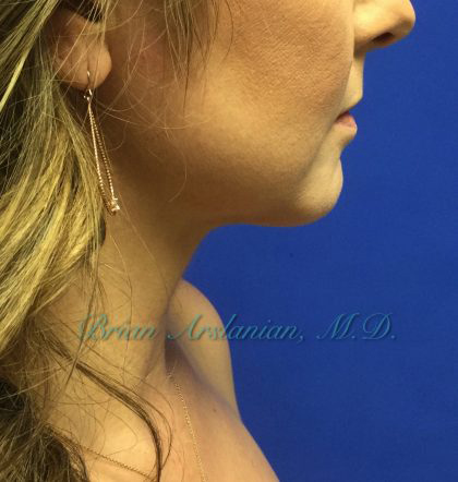 Neck Liposuction case #3821