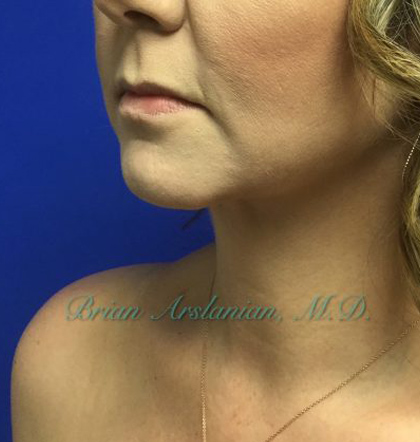 Neck Liposuction case #3821